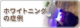 ホワイトニングの症例